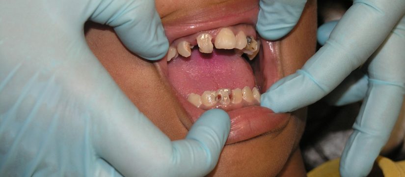 Toothache: Causes and Treatments